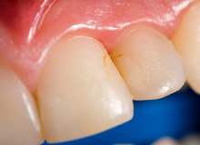 Diş Temizleme İşlemiyle Süt Beyazı Dişler