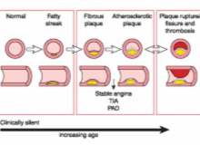Ateroskleroz Ateroskleroz