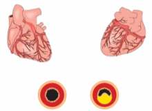 Kalp Hastalıkları ve Kronik Anjin İçin Geliştirilmiş Dış Kontrpulsasyon Kalp Hastalıkları ve Kronik Anjin İçin Geliştirilmiş Dış Kontrpulsasyon