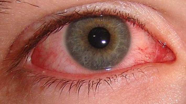 Göz Yangısı (Konjonktivit)