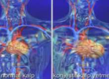 Kalp Hastalıkları ve Dilate Kardiyomiyopati Kalp Hastalıkları ve Dilate Kardiyomiyopati