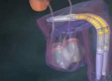 Sertleşme Bozukluğu Sertleşme Bozukluğu