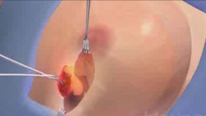 Meme Kanseri Tedavisi