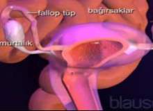 Rahim Ağzı Kanseri Rahim Ağzı Kanseri