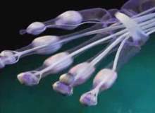 Osteokondritis Dissekans Osteokondritis Dissekans