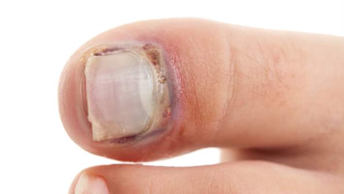 Halluks Rijidus (Başparmak Artriti)