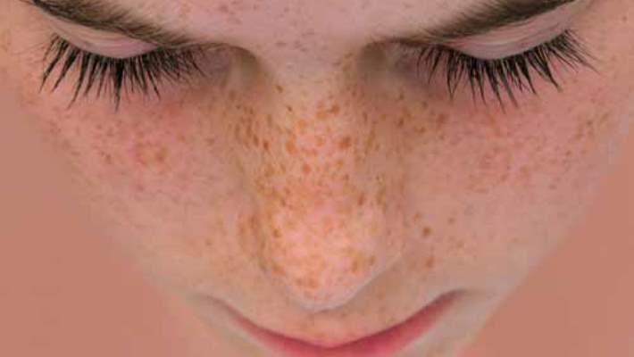 Bağımlı Kişilik Bozukluğu