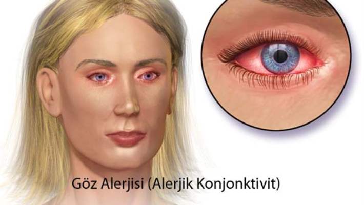 Konjunktiva İltihapları