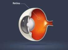 Retina Ayrılması Retina Ayrılması