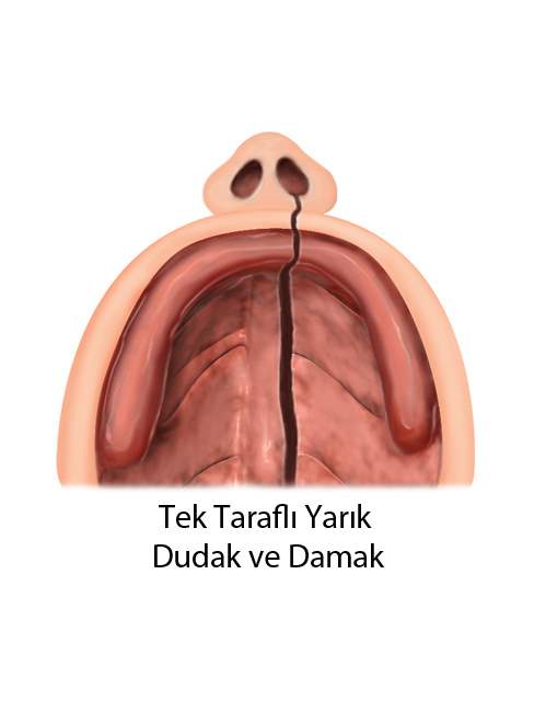Yarık Dudak ve Yarık Damak