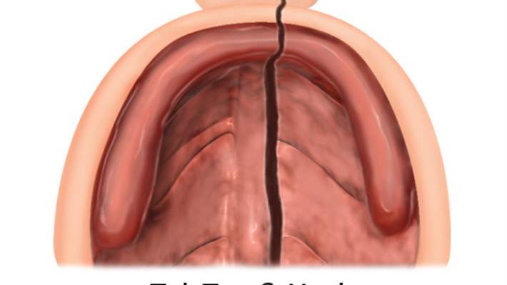 Yarık Dudak Ve Yarık Damak