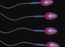Spermatosel (Epididimal Kist) Spermatosel (Epididimal Kist)