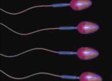 Spermatosel (Epididimal Kist)