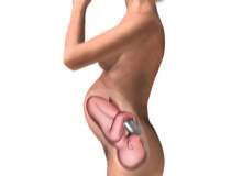 Fetal Alkol Sendromu Fetal Alkol Sendromu