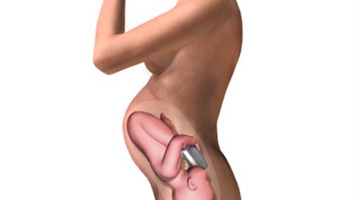 Fetal Alkol Sendromu