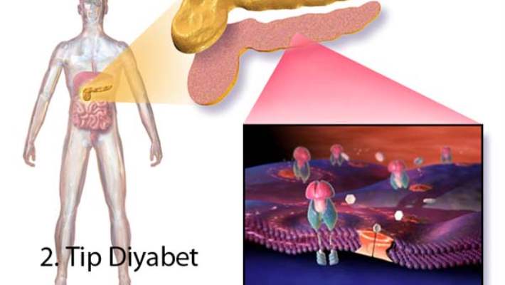 Tip-2 Diyabet Hastaların Yaşam Kalitesini Düşürüyor