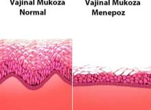 Bakteriyel Vajinozis Bakteriyel Vajinozis