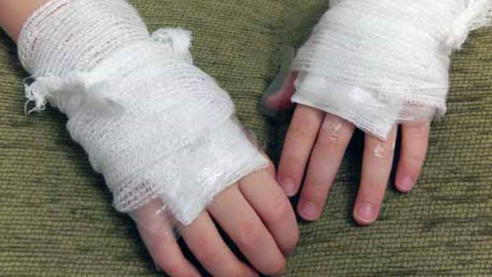 Nekrotizan Fasiit (Et Yiyen Bakteri)