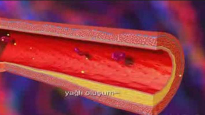 Venöz Yetmezlik (Damar Yetmezliği)