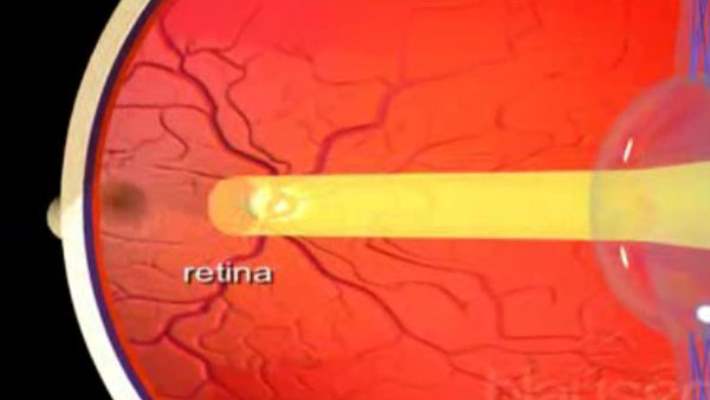 Retina Bozuklukları