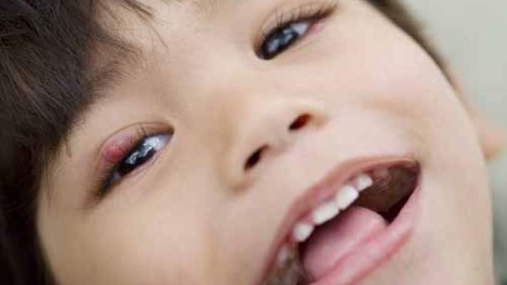 Çocukta Şaşılık