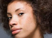 Kozmetik İşlemler, Doğum Lekeleri ve Diğer Anormal Deri Pigmentasyonları Kozmetik İşlemler, Doğum Lekeleri ve Diğer Anormal Deri Pigmentasyonları