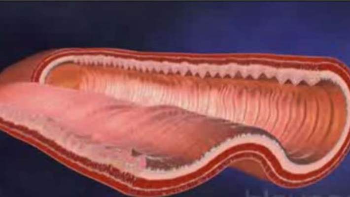 Bağırsakta Lenf Kanalları Genişlemesi (İntestinal Lenfanjiektazi)