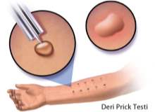 Dermoid Kist Dermoid Kist