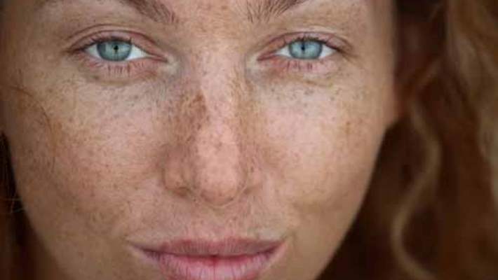 Stevens-Johnson Sendromu