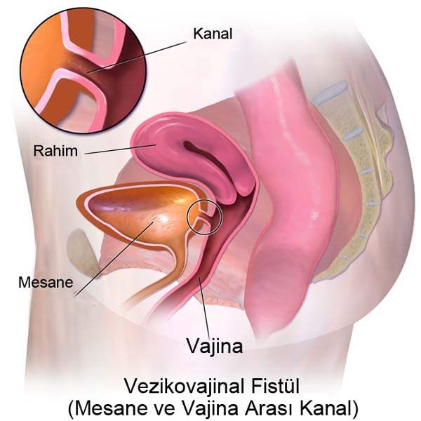 vajinal atrofi hemen saglik