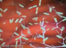 Vajinal Mantar Enfeksiyonu (Vajinal Maya Enfeksiyonu) Vajinal Mantar Enfeksiyonu (Vajinal Maya Enfeksiyonu)