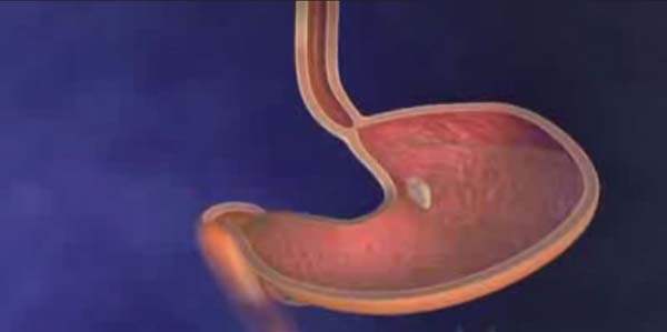 Mide Düşüklüğü (Gastroptoz)