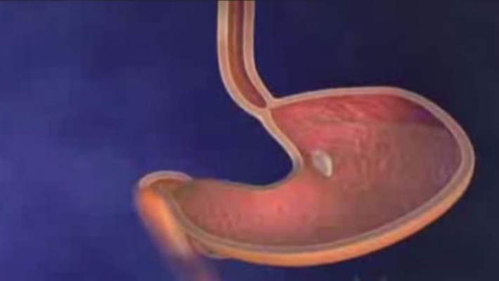Mide Düşüklüğü (Gastroptoz)