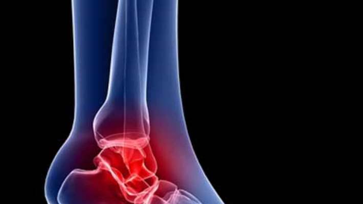 Tarsal Tünel Hastalığı