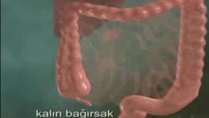 Hirschsprung Hastalığı