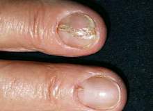 Tırnak Yaralanmaları Tırnak Yaralanmaları