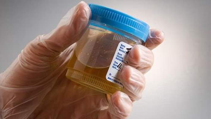 İnterstisyel Sistit