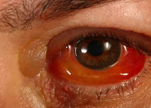 Hiperemi Nedir?