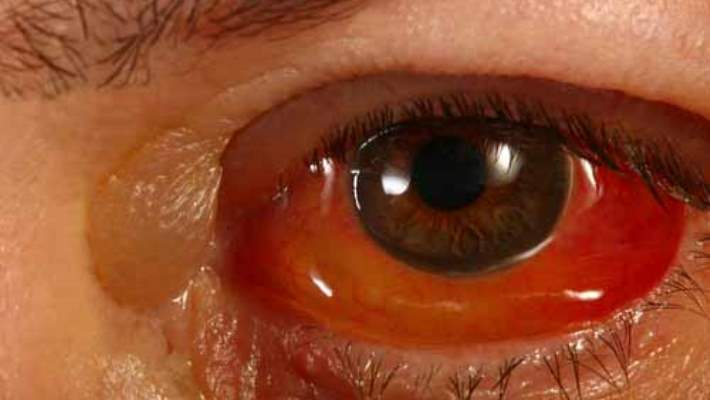 Hiperemi Nedir?