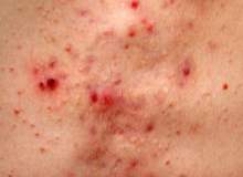 Hidradenitis Suppurativa (Akne Inversa) Hidradenitis Suppurativa (Akne Inversa)