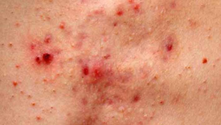 Hidradenitis Suppurativa (Akne Inversa)