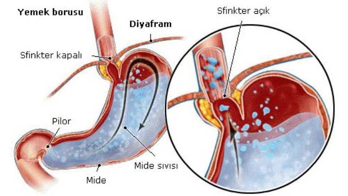 Mide Ülseri