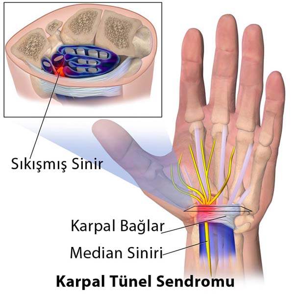 Karpal Tünel Sendromu