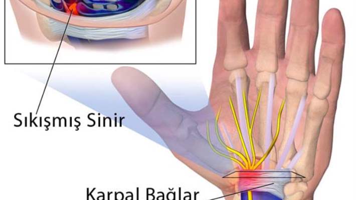 Karpal Tünel Sendromu