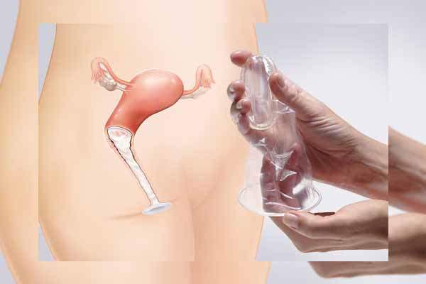 Genital Siğil