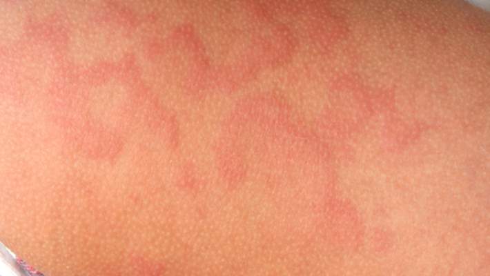 kurdesen urtiker hemen saglik