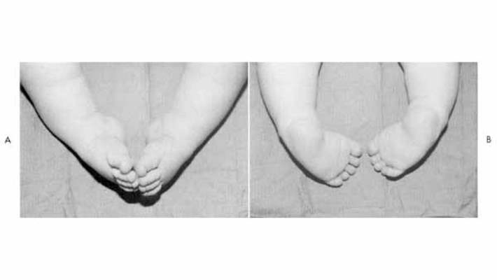 Doğuştan Çarpık Ayak (Pes Ekino Varus Pev)