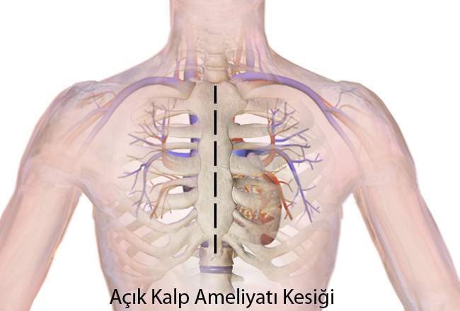 Kalp Nakli Nedir?