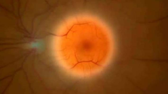 Yaşa Bağlı Maküla Dejenerasyonu (Ybmd)