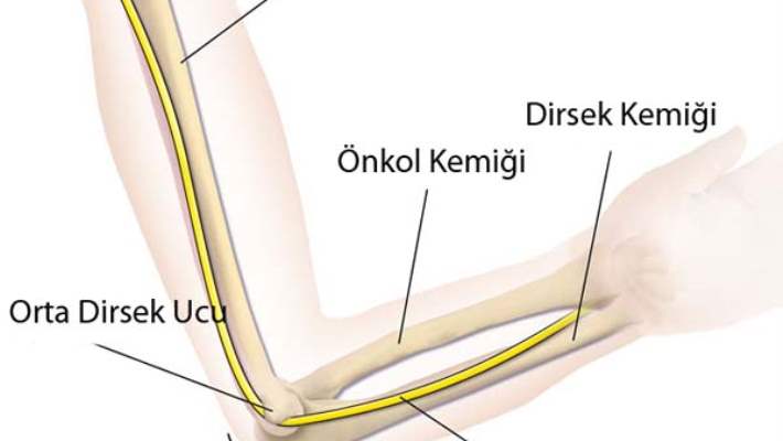 Ulnar Sinir Sıkışması